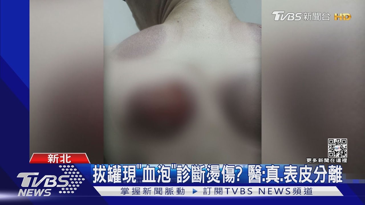 拔罐現「血泡」診斷燙傷? 醫:真、表皮分離