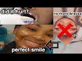 TAKING OFF MY BRACES AFTER 5 YEARS EVERYTHING YOU NEED TO KNOW | JAZMINE V TAKING OFF MY BRACES AFTER 5 YEARS EVERYTHING YOU NEED TO KNOW | JAZMINE V