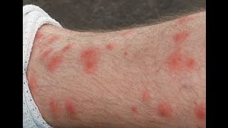 HOW TO - Get Rid of Chigger Bites and Stop Itching Naturally