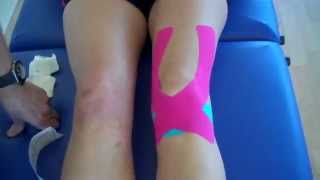 ACUPUNTURA CURITIBA - TAPING PARA DOR NO JOELHO