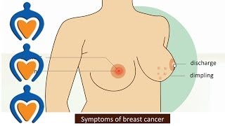 Breast cancer Symptoms and treatment Mp4 3GP & Mp3