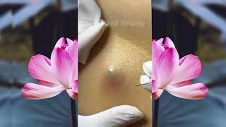 Big Blackhead ingrown hair removal Disgusting