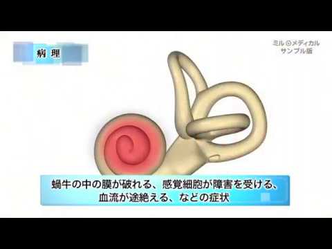 騒音性難聴(職業病) - 定義
