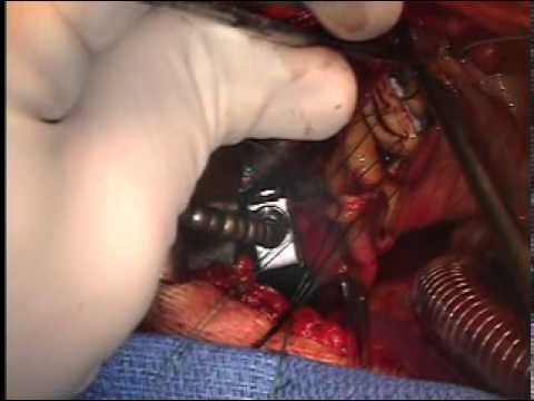 Aortic Valve Replacement With A Tissue Valve - Minimally Invasive Technique 