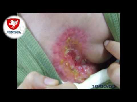 เลี้ยงลูกด้วยนมครีม ว่าจะเลี้ยงนมหลังจาก mammoplasty