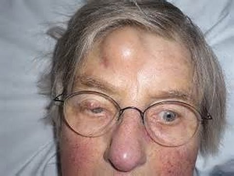 FUNNY Ways To Pop A Cyst | Sebaceous Cyst Removal Treatment