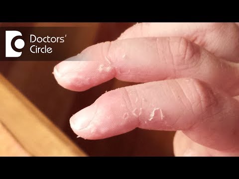 What causes skin peeling of fingers in a child? - Dr. Varsha Saxena