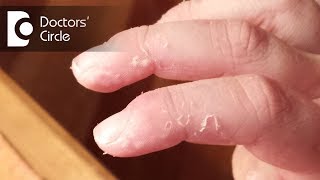 What causes skin peeling of fingers in a child? - Dr. Varsha Saxena