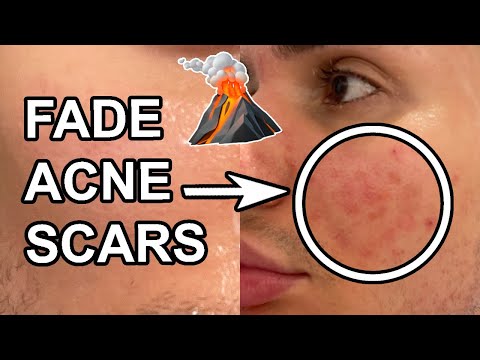 How to GET RID OF ACNE SCARS in 2 weeks! (PIH & PIE) || Best products for hyperpigmentation