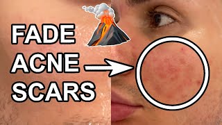How to GET RID OF ACNE SCARS in 2 weeks! (PIH & PIE) || Best products for hyperpigmentation
