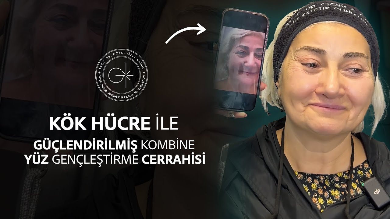 10. AY KONTROLÜ | KOMBİNE YÜZ GENÇLEŞTİRME CERRAHİSİ #yüzgençleştirme #kökhücre #yüzestetiği