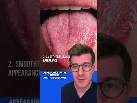 Signs of IRON DEFICIENCY ANAEMIA in the TONGUE | Glossitis explained #shorts  #health #anaemia