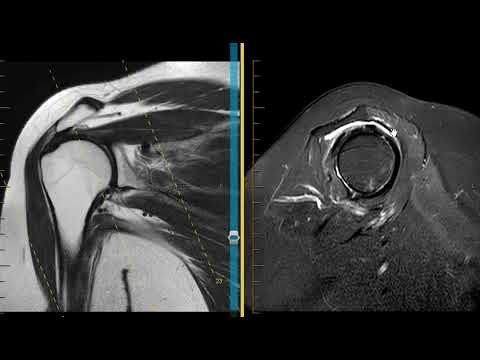 Shoulder impingement with rotator cuff tendinopathy and labral tear