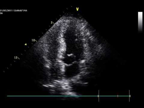 Excess Mitral Tissue Moving Into The Left Ventricular Outflow Tract Without Subaortic Obstruction