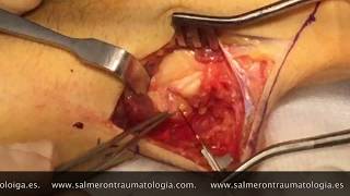 SECCION Y REPARACION DE NERVIO CUBITAL