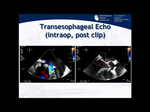 Transcatheter Treatment of Postsurgical MR With Mitral Clip - Mario Goessl, MD