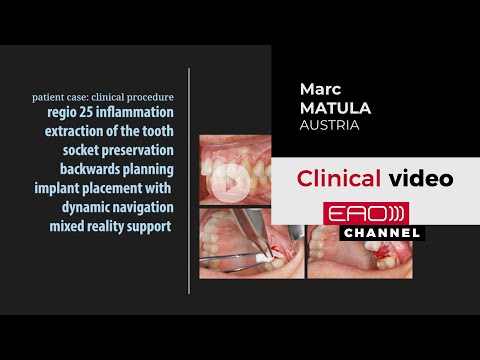 Beyond Reality: Using Holograms & Dynamic Navigation in Implant Surgery