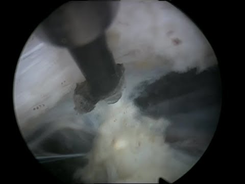 Bewertungen von Kliniken Prostatitis Entfernen Sie den Stein in der Prostata