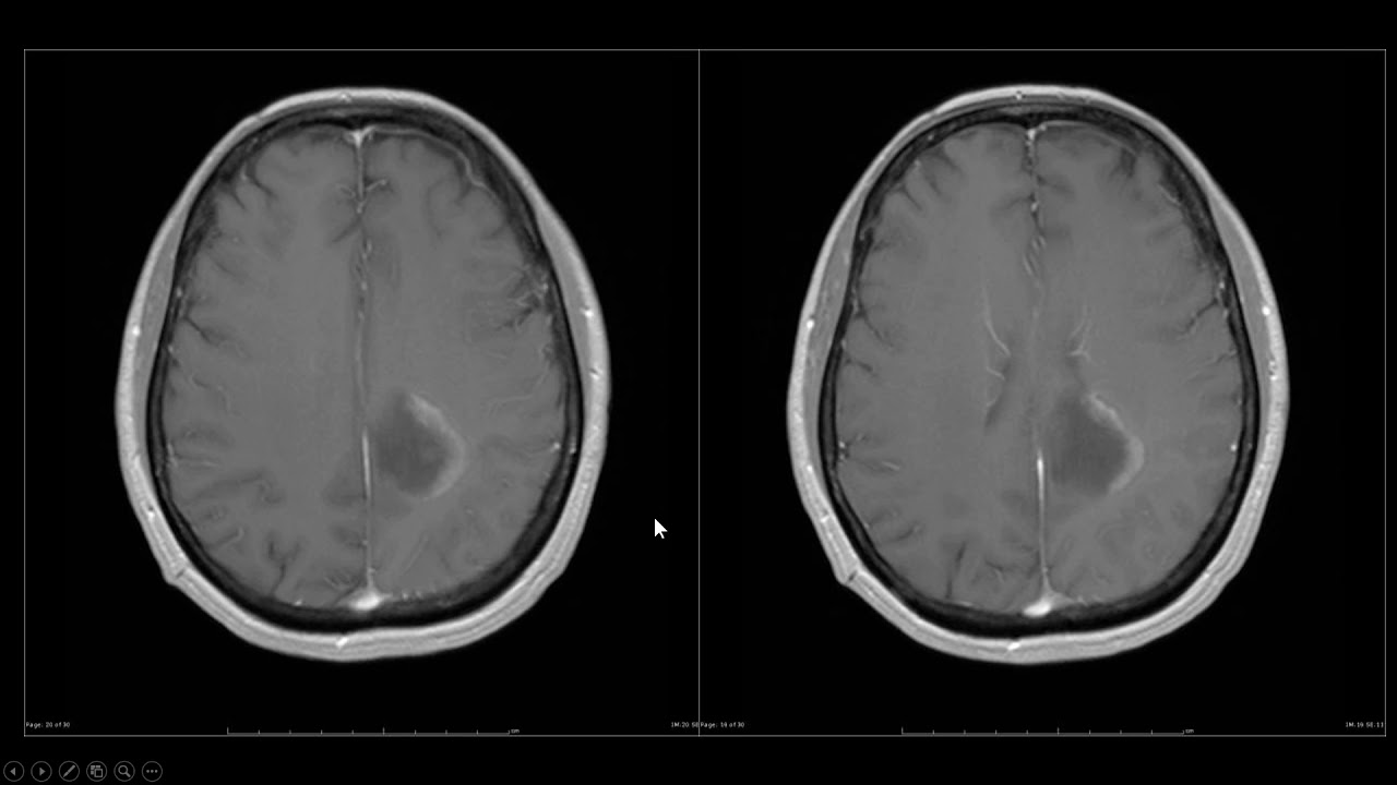 Doença desmielinizante