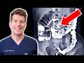 Barium Enema A Guide To This Colon X Ray Test