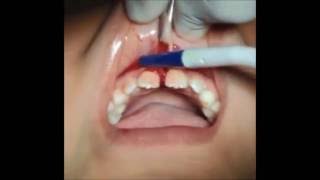 Cirugía de frenectomia labial paso a paso - Frenectomy labial-diastema closure- Dr. Britto Falcón