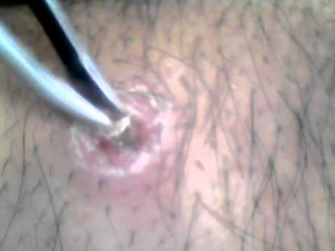 ลีโอฟาโรคสะเก็ดเงิน การรักษาแบบดั้งเดิม neurodermatitis