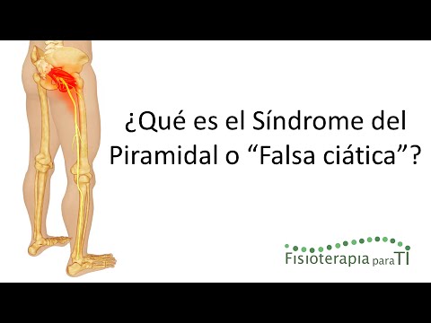 Piriformis syndrome or "false sciatica": What it is, why it occurs, how to recognize it, and trea...