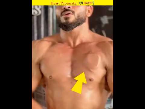 This is how a heart pacemaker works