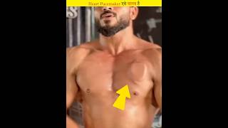 This is how a heart pacemaker works