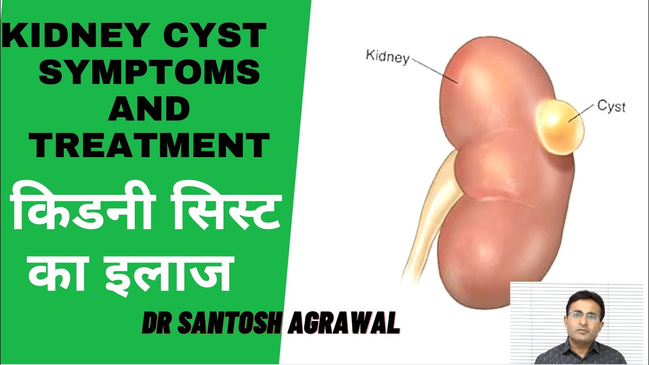 Kidney Cyst Treatment I Renal Cyst I Kidney Ki Gathan