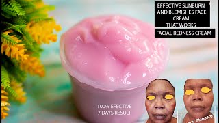 CALM SENSITIVE RED FACE / HOW TO TREAT REDNESS ON FACE | HOW TO TREAT SUNBURN AND IRRITATIONS #DIY