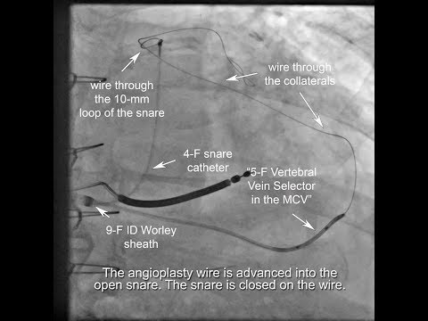 Antidromic snare + Venoplasty + use of micro catheter inside vein selector to traverse collaterals