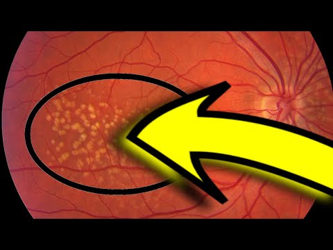 Wet vs Dry Macular Degeneration
