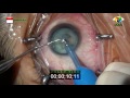 Cataract Surgery - Operasi Katarak 1093