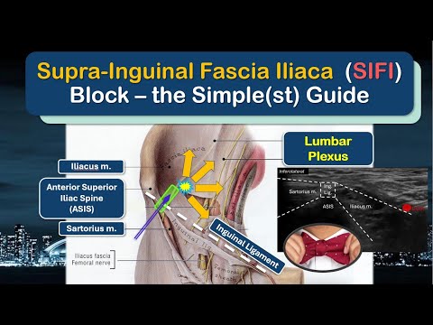 Fascia Iliaca Block - a Definitive "How-To" Guide [2025]