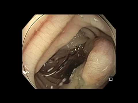 Colonoscopy: Sigmoid Colon Pedunculated Polyp Resection Underwater