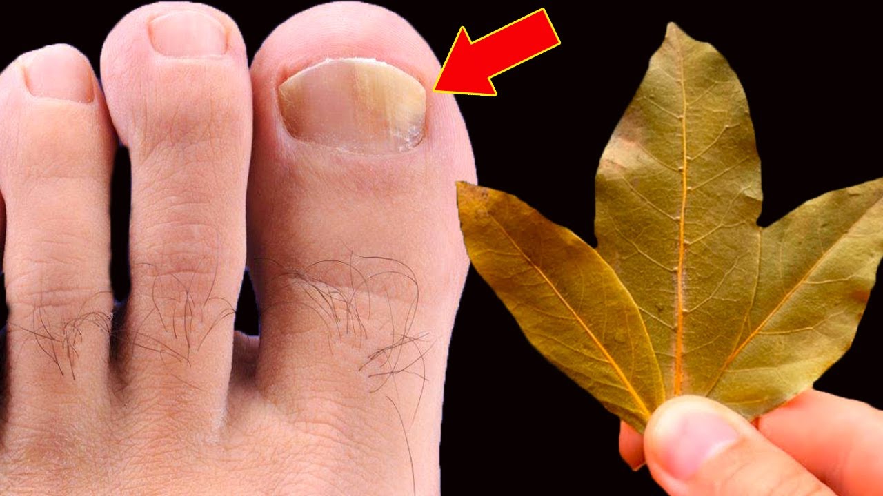 🔥 Eliminates nail fungus instantly! Don't spend any more money at the pharmacy!