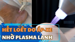 PlasmaMED: Tia plasma lạnh điều trị cho bênh nhân có vết loét lâu lành do áp – xe