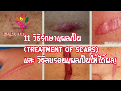 โรคสะเก็ดเงินละติน รักษาใหม่สำหรับโรคสะเก็ดเงินในปี 2014