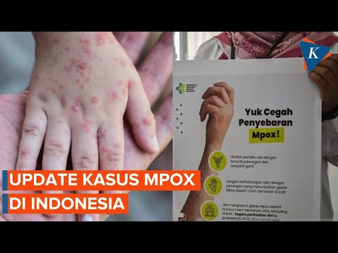 Kronologi Mpox Masuk ke Indonesia dari Luar Negeri, Kini Sudah 88 Kasus Halaman all - Kompas