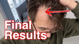 iRestore Red Light Helmet Final Results for Hair Loss