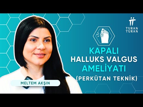 Minimally Invasive Bunion Surgery: Fast Recovery & Results