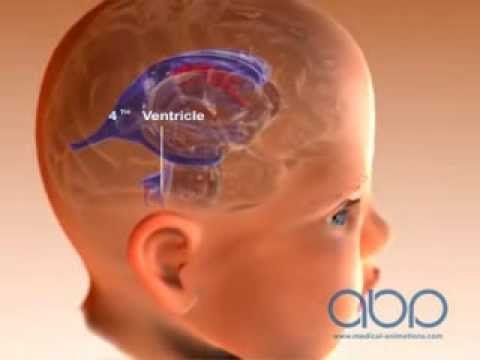 Brain Ventricle of a Baby