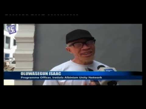 Save 50 Children with Albinism in from Skin Cancer