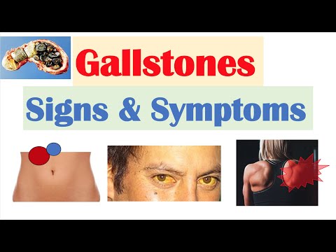 Gallstones Signs & Symptoms, Why They Occur | Cholecystitis, Choledocholithiasis, Cholangitis
