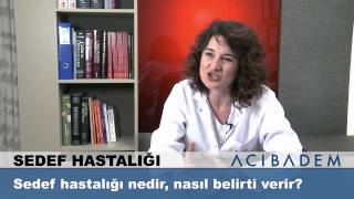 Sedef hastalığı nedir nasıl belirti verir 