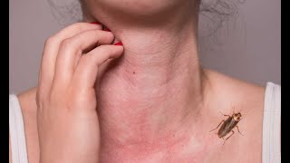 The Dangers Of Cockroach Allergens