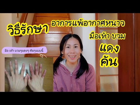 แพ้อากาศหนาว มือ เท้า บวมๆ แดงๆ คันๆ รักษาง่ายๆ ด้วยวิธีนี้