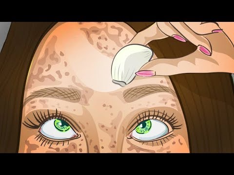 Лечение пигментных пятен солнцем Как избавиться от пигментных пятен на теле от прыщей