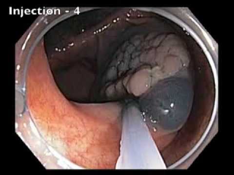 Zastawka krętniczo-kątnicza: płaska zmiana - endoskopowa resekcja śluzówki (pełny zabieg)